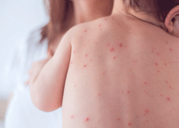 Autoridades de salud en el Valle descartan epidemia de varicela en la región