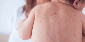 Autoridades de salud en el Valle descartan epidemia de varicela en la región