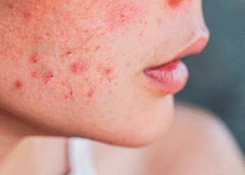 El acné afecta  a 90% de la población joven en Colombia