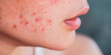 El acné afecta  a 90% de la población joven en Colombia