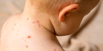 Colombia no está libre de sufrir un brote de rubeola o sarampión; llamado a completar esquemade vacunación