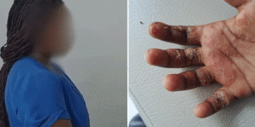 Mujer que le quemó las manos a su hija de 7 años fue capturada