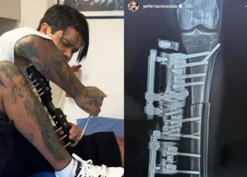 Influencer se realizó cirugía de alargamiento de piernas para verse más alto