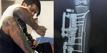 Influencer se realizó cirugía de alargamiento de piernas para verse más alto