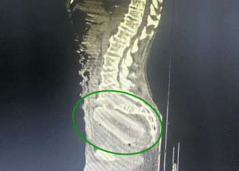 Hombre de 72 años ingresó a hospital de Tuluá con un objeto extraño en su cuerpo