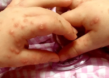 Brote viral activa alertas sanitarias en niños de Tuluá