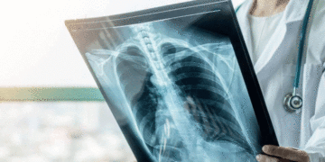 Autoridades de salud emiten alerta por casos de tuberculosis en el Valle del Cauca