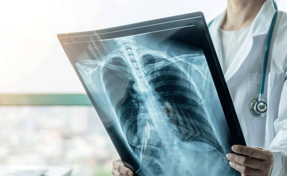 Autoridades de salud emiten alerta por casos de tuberculosis en el Valle del Cauca