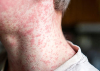 Más de 14 mil casos de sarampión en América encienden alarma en Colombia