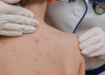 Valle advierte riesgo por falta de vacunas contra el sarampión