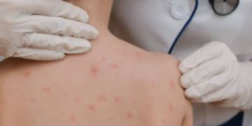 Valle advierte riesgo por falta de vacunas contra el sarampión