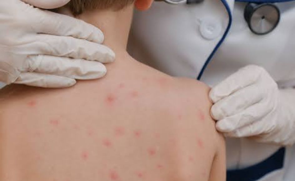 Valle advierte riesgo por falta de vacunas contra el sarampión