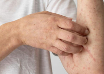 Valle del Cauca refuerza controles ante riesgo de casos importados de sarampión