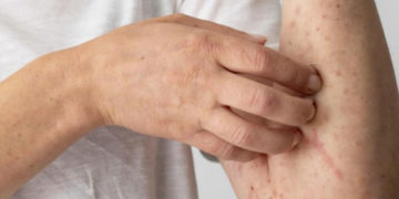 Valle del Cauca refuerza controles ante riesgo de casos importados de sarampión