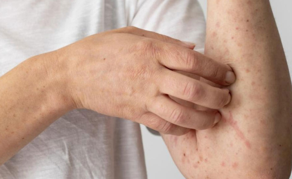 Valle del Cauca refuerza controles ante riesgo de casos importados de sarampión