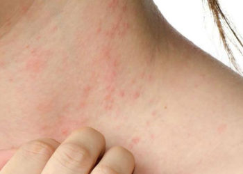 Dermatitis atópica severa: una enfermedad que impacta más allá de la piel