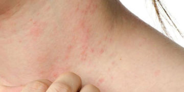 Dermatitis atópica severa: una enfermedad que impacta más allá de la piel