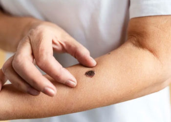 Hospital Tomás Uribe Uribe realizará jornada de detección de cáncer de piel en Tuluá