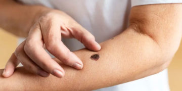 Hospital Tomás Uribe Uribe realizará jornada de detección de cáncer de piel en Tuluá