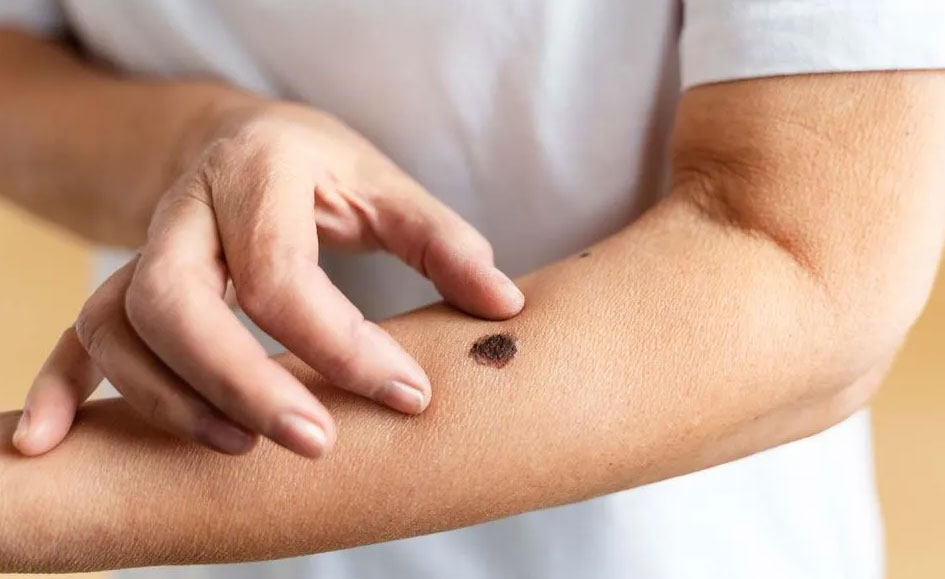 Hospital Tomás Uribe Uribe realizará jornada de detección de cáncer de piel en Tuluá