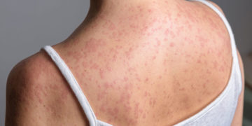 Ministerio de Salud refuerza el llamado a la vacunación tras quinto caso de sarampión