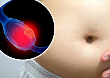 El cáncer de ovario podría detectarse antes si se identifican estos síntomas