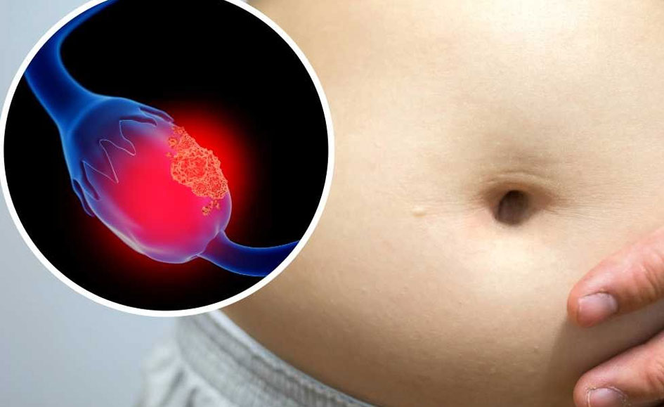 El cáncer de ovario podría detectarse antes si se identifican estos síntomas