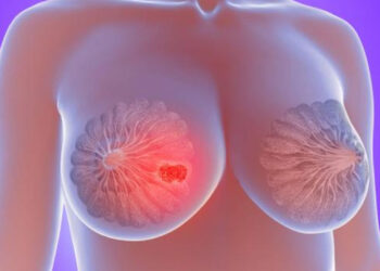 La picazón persistente en el pezón podría ser una señal temprana de cáncer de mama