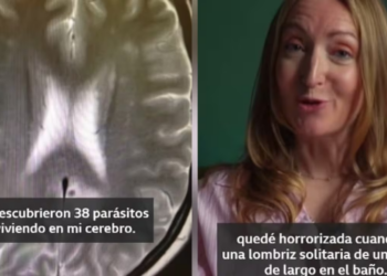 Lo que comió en la India le dejó 38 parásitos alojados en el cerebro