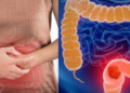 Este cambio en las heces podría ser una señal de cáncer colorrectal