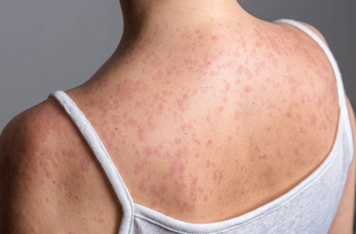 Ministerio-de-Salud-refuerza-llamado-a-la-vacunaci{on-tras-confirmaci{on-de-quinto-caso-de-Sarampion